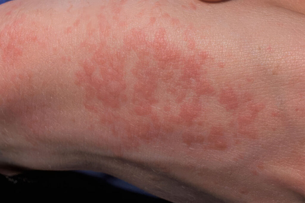 Heat rash, commonly known as prickly heat, sweat rash, or miliaria, presents as a skin condition characterized by pimple-like eruptions due to clogged sweat ducts. Source: nidirect.gov.uk