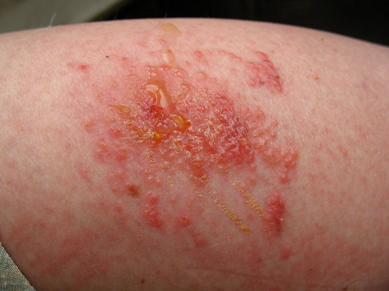 Blisters may form and even break open after contact with urushiol oil. If they appear, they should be left alone as popping them may lead to infection. Source: Vilseskoge @flickr.com