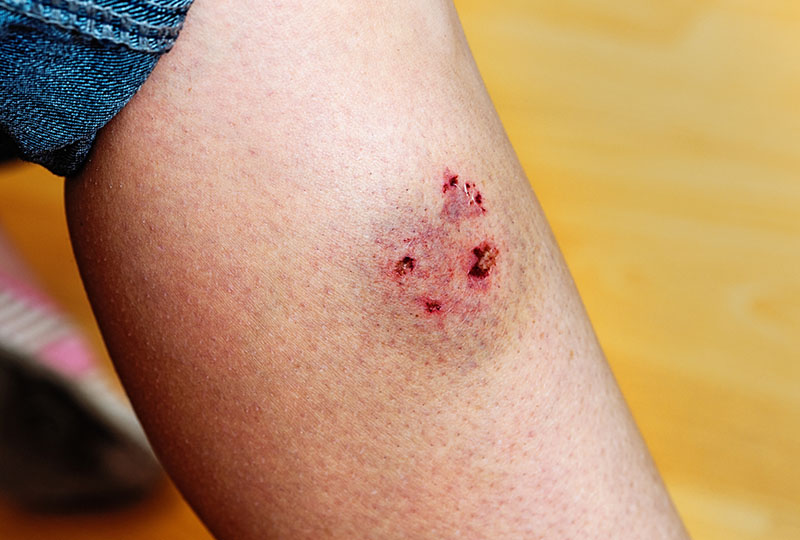 A photo of a dog bite on someone's lower leg.